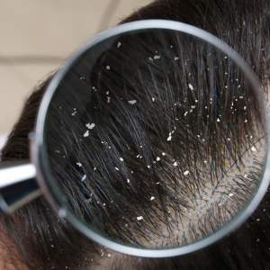 Hair Loss & Dandruff
